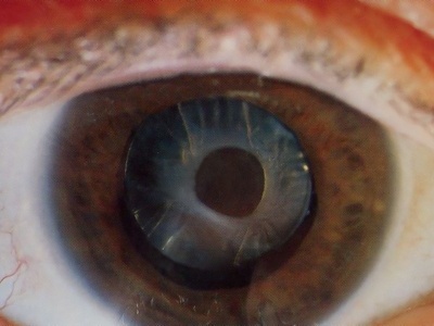 Eye- image source ophthalmologyweb